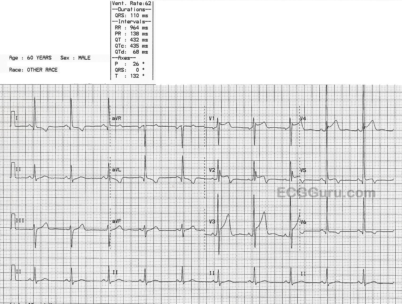 Occlusion Myocardial Infarction ECG Guru Instructor Resources occlusion-myocardial-infarction-ecg-guru-instructor-resources